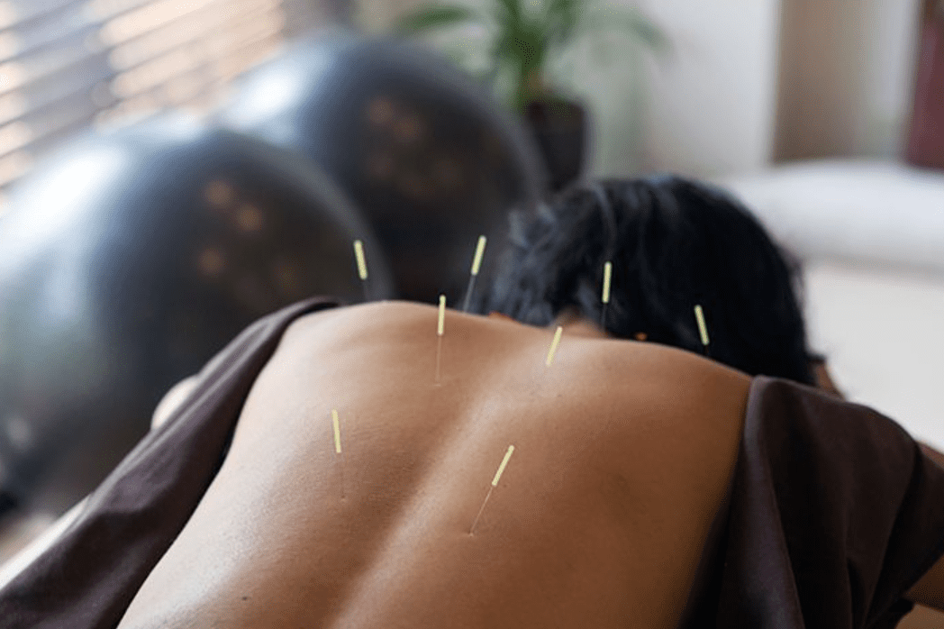 Lasting Chronic Pain Relief in Aventura, Sunny Isles Hallandale – No Surgery or Meds Required science of acupuncture